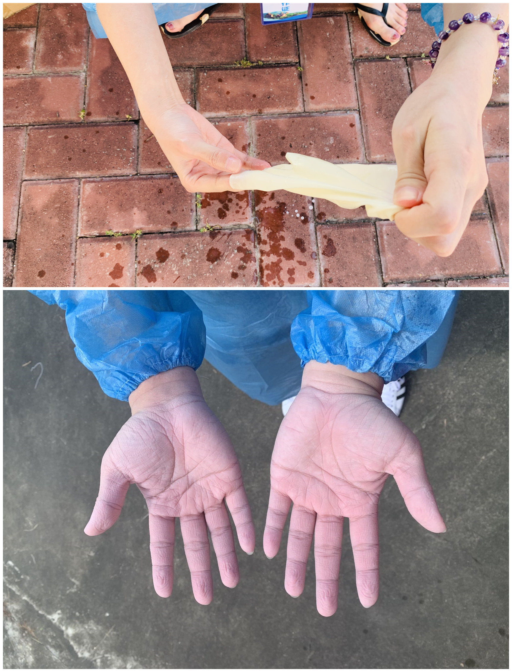 防疫一線工作人員的雙手：脫掉手套，在汗水和消毒液浸泡下發(fā)皺變白.jpg
